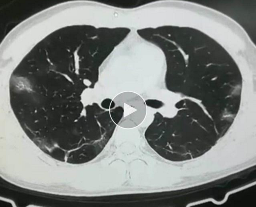 新冠肺炎肺部照片图片